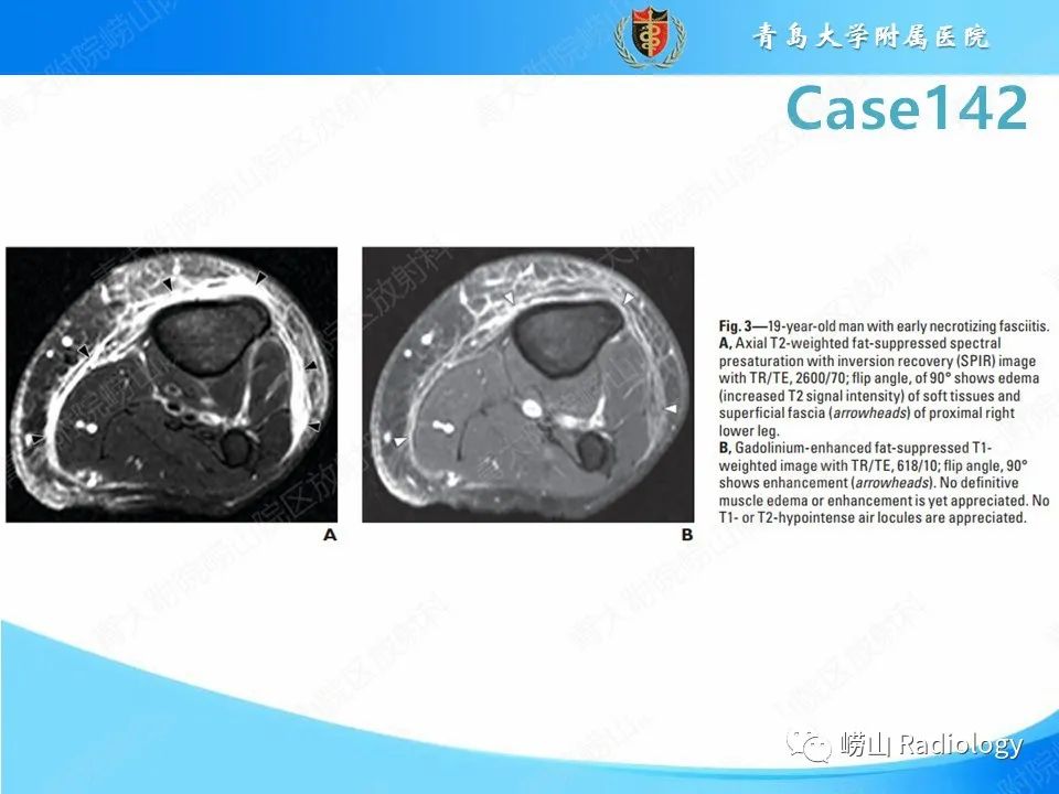 影像PPT - 【PPT】坏死性筋膜炎-18