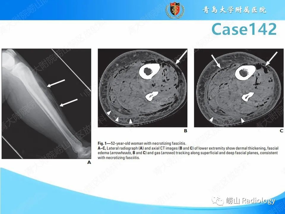影像PPT - 【PPT】坏死性筋膜炎-17