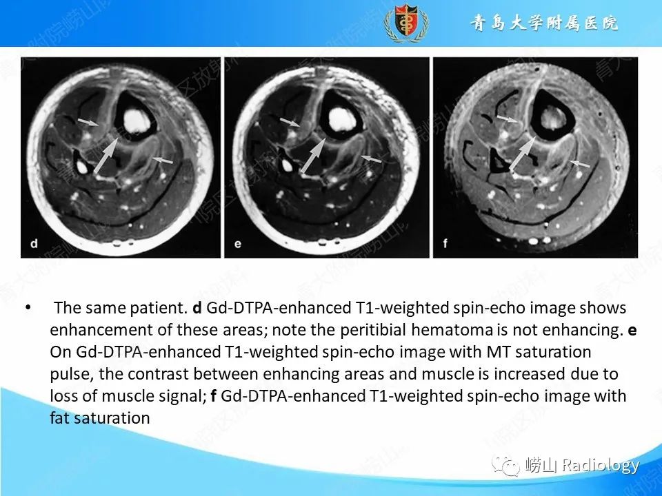 影像PPT - 【PPT】坏死性筋膜炎-22