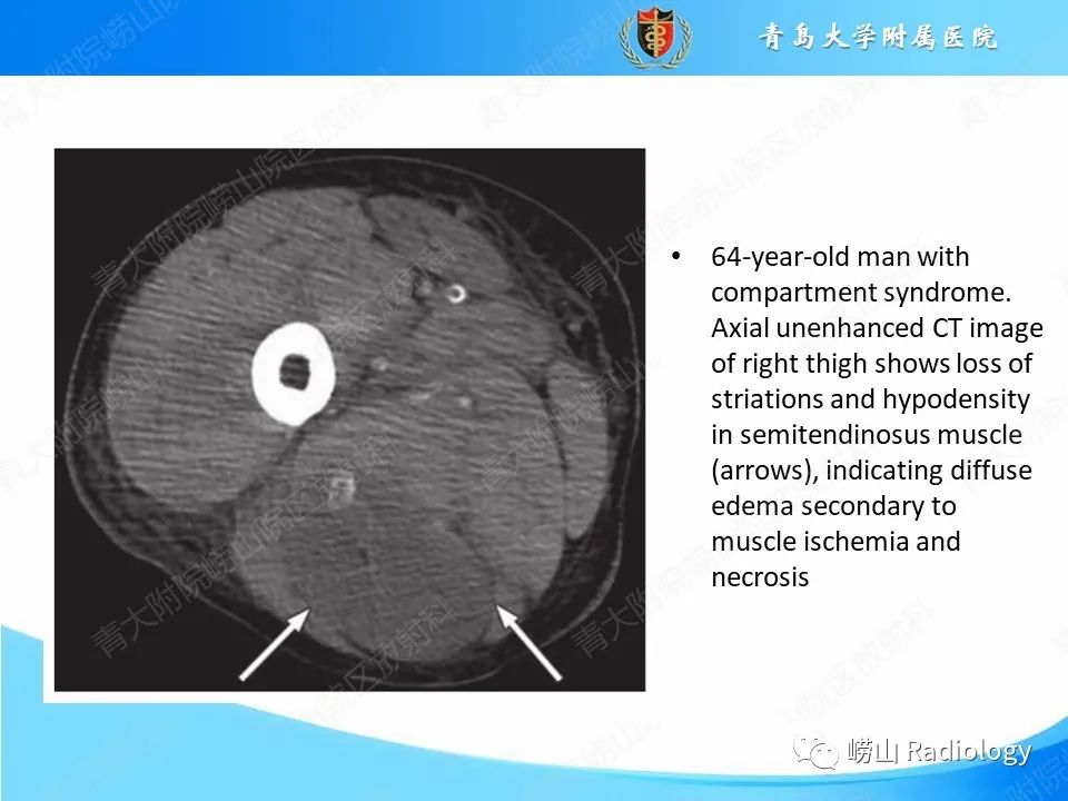 影像PPT - 【PPT】坏死性筋膜炎-23