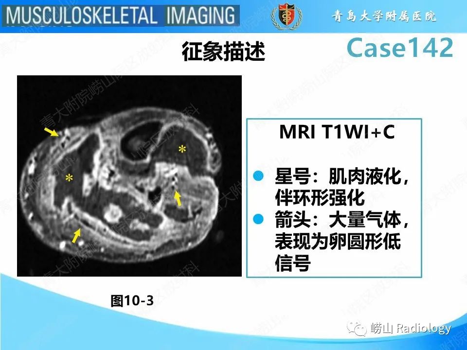 影像PPT - 【PPT】坏死性筋膜炎-15