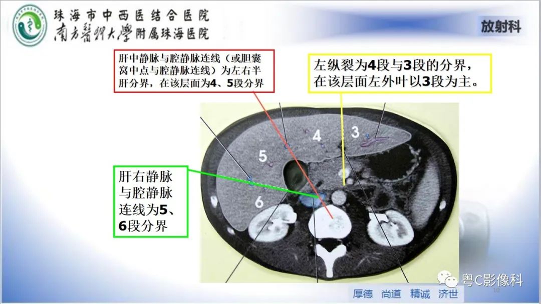 影像PPT - 【PPT】肝脏影像分段及肝硬化结节MRI诊断-10