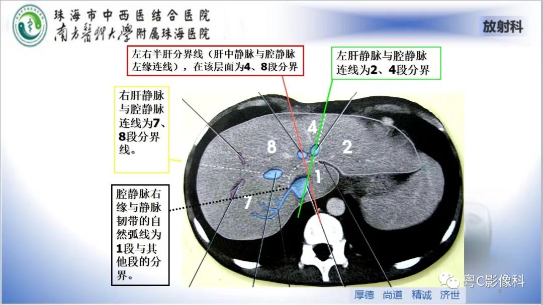 影像PPT - 【PPT】肝脏影像分段及肝硬化结节MRI诊断-8