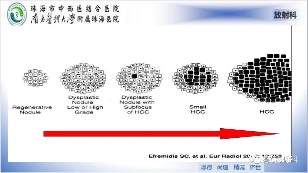 影像PPT - 【PPT】肝脏影像分段及肝硬化结节MRI诊断-13
