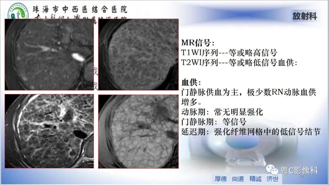 影像PPT - 【PPT】肝脏影像分段及肝硬化结节MRI诊断-18