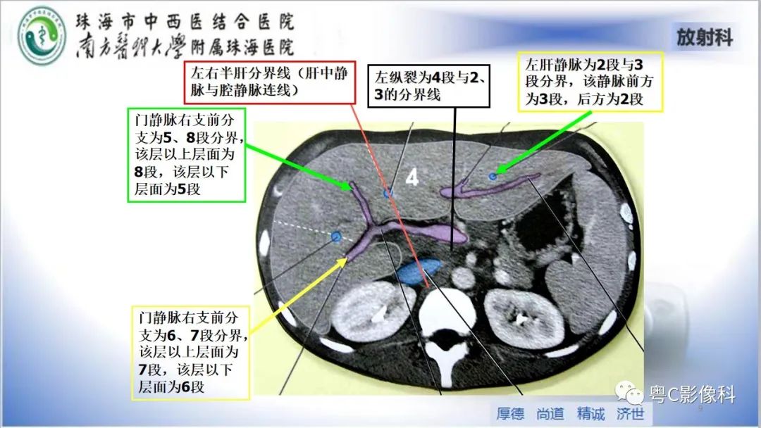 影像PPT - 【PPT】肝脏影像分段及肝硬化结节MRI诊断-9