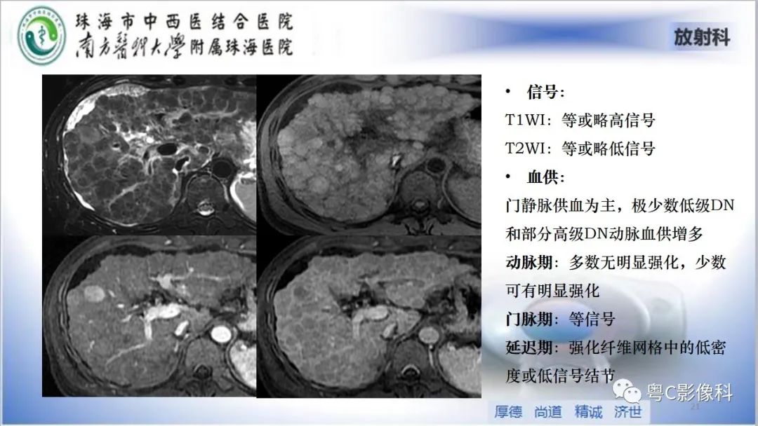 影像PPT - 【PPT】肝脏影像分段及肝硬化结节MRI诊断-21