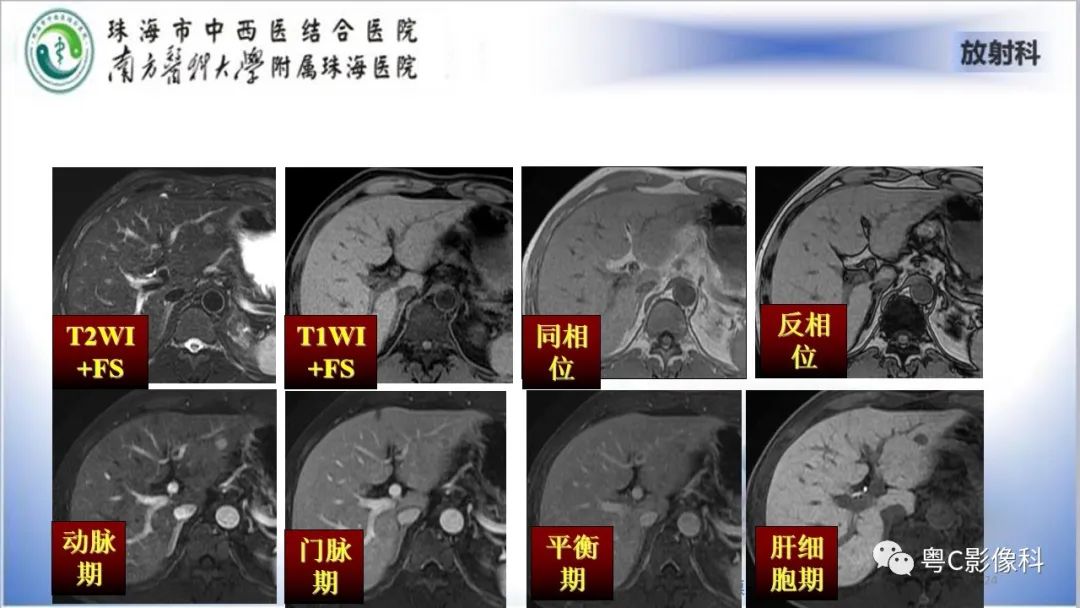影像PPT - 【PPT】肝脏影像分段及肝硬化结节MRI诊断-24