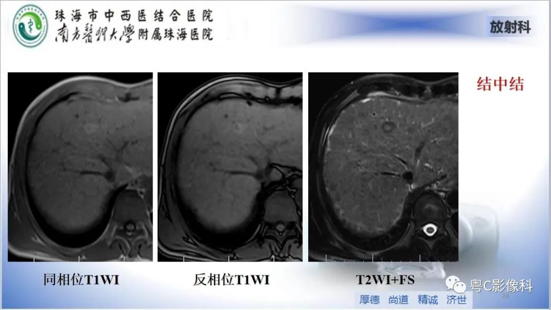 影像PPT - 【PPT】肝脏影像分段及肝硬化结节MRI诊断-28