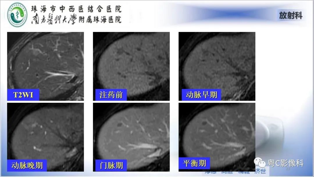 影像PPT - 【PPT】肝脏影像分段及肝硬化结节MRI诊断-23