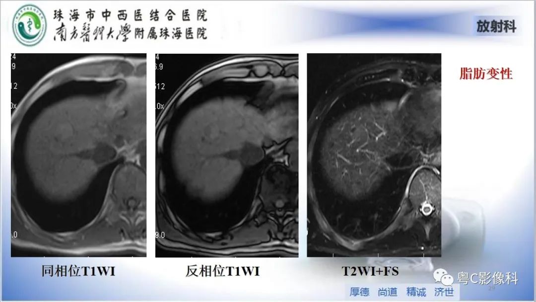 影像PPT - 【PPT】肝脏影像分段及肝硬化结节MRI诊断-29