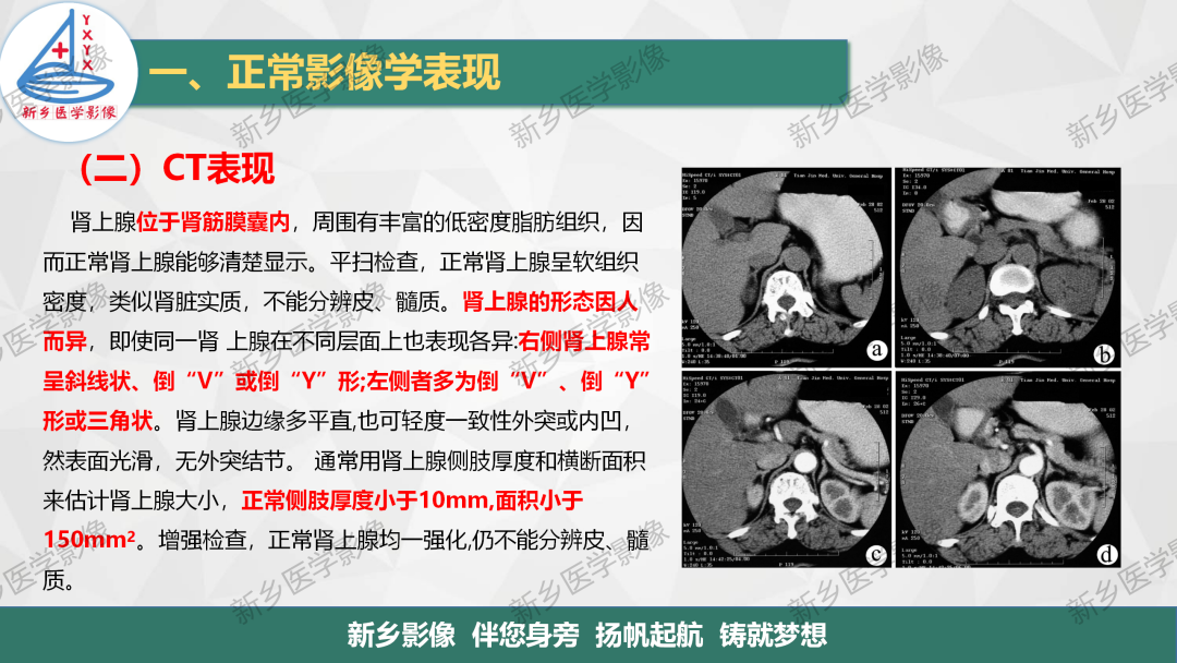 影像PPT - 【PPT】肾上腺解剖及常见疾病诊断要点-5
