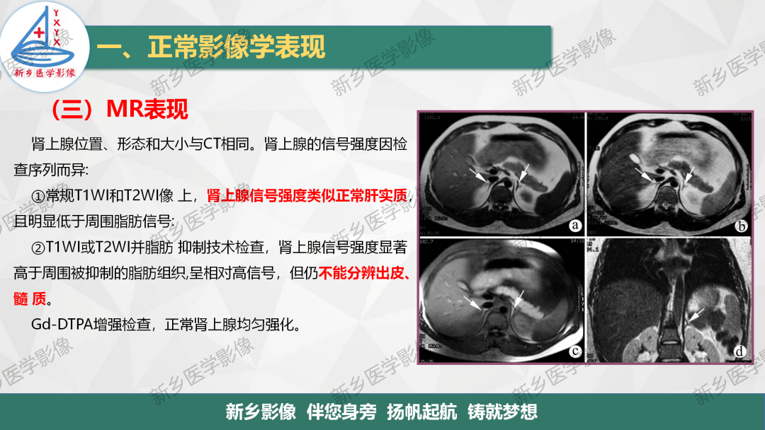 影像PPT - 【PPT】肾上腺解剖及常见疾病诊断要点-6