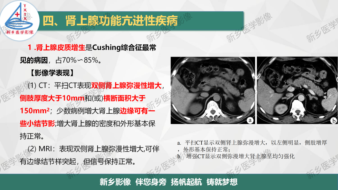 影像PPT - 【PPT】肾上腺解剖及常见疾病诊断要点-14