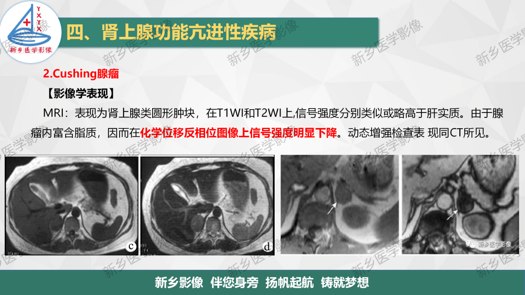 影像PPT - 【PPT】肾上腺解剖及常见疾病诊断要点-18