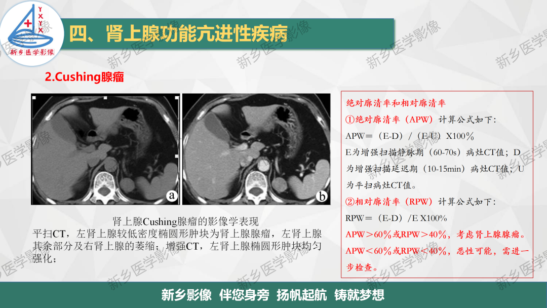 影像PPT - 【PPT】肾上腺解剖及常见疾病诊断要点-17