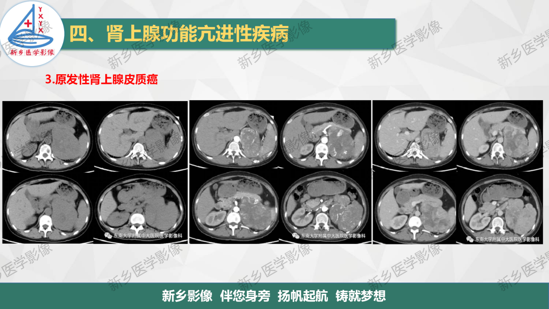 影像PPT - 【PPT】肾上腺解剖及常见疾病诊断要点-20