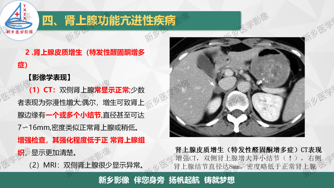 影像PPT - 【PPT】肾上腺解剖及常见疾病诊断要点-26