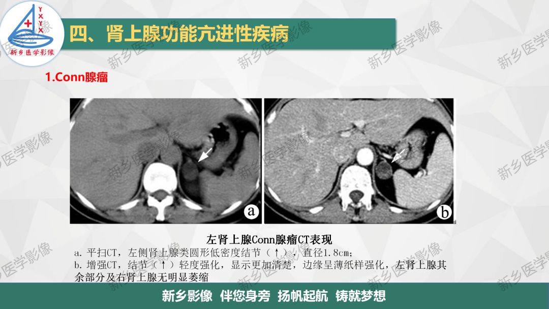 影像PPT - 【PPT】肾上腺解剖及常见疾病诊断要点-25