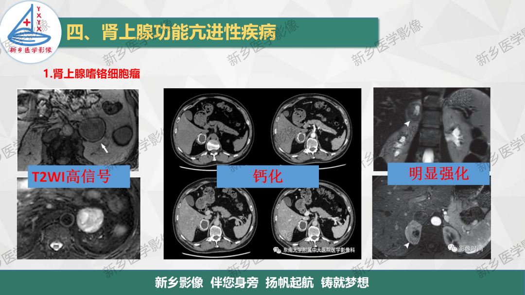 影像PPT - 【PPT】肾上腺解剖及常见疾病诊断要点-32