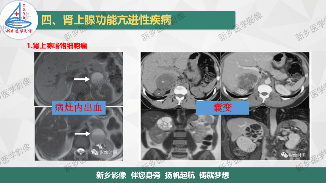 影像PPT - 【PPT】肾上腺解剖及常见疾病诊断要点-31