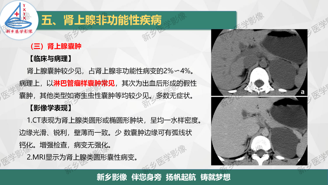影像PPT - 【PPT】肾上腺解剖及常见疾病诊断要点-43