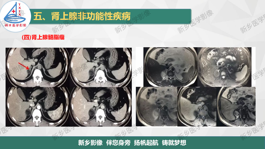 影像PPT - 【PPT】肾上腺解剖及常见疾病诊断要点-45