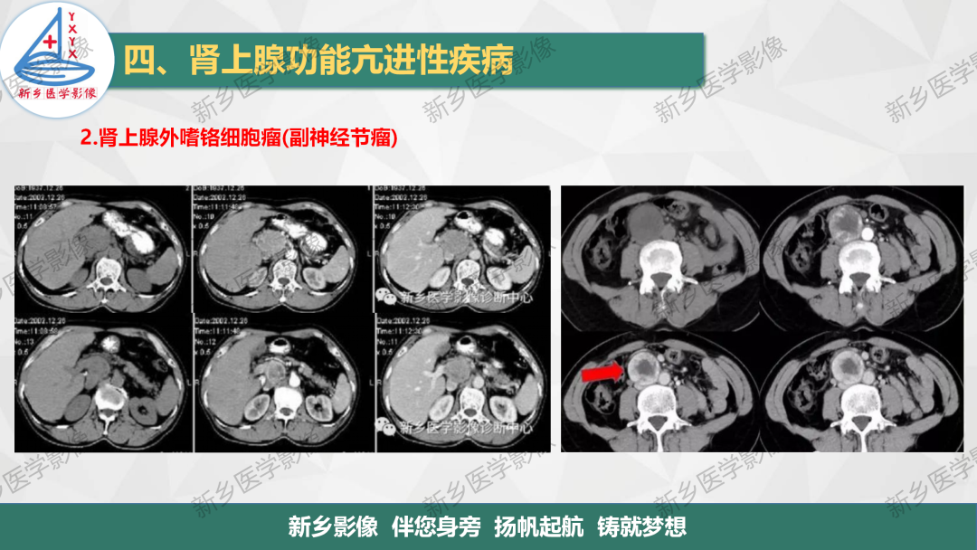 影像PPT - 【PPT】肾上腺解剖及常见疾病诊断要点-36