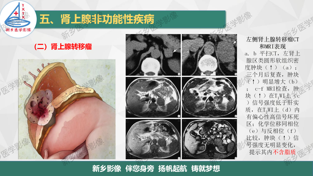 影像PPT - 【PPT】肾上腺解剖及常见疾病诊断要点-41