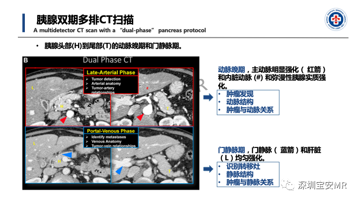 影像PPT - 【PPT】多模态影像对于胰腺癌分期意义-12