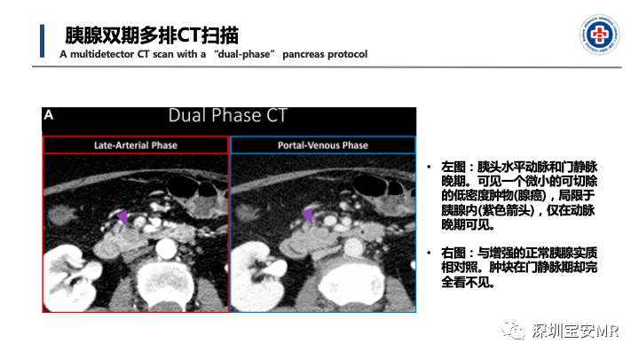 影像PPT - 【PPT】多模态影像对于胰腺癌分期意义-10