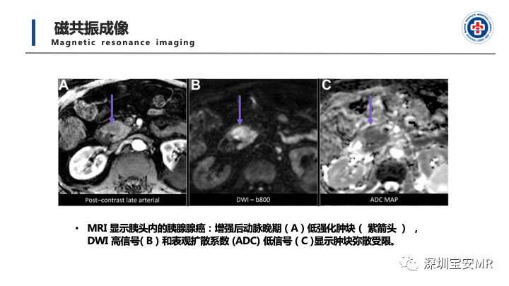 影像PPT - 【PPT】多模态影像对于胰腺癌分期意义-20