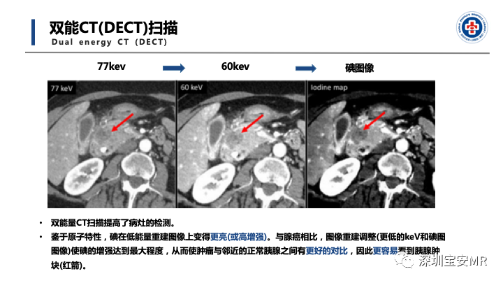 影像PPT - 【PPT】多模态影像对于胰腺癌分期意义-14