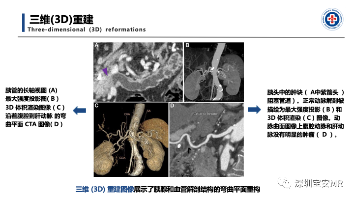 影像PPT - 【PPT】多模态影像对于胰腺癌分期意义-16