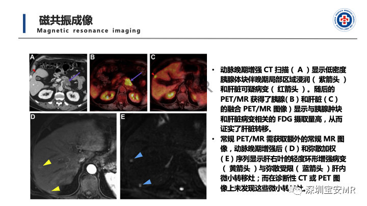 影像PPT - 【PPT】多模态影像对于胰腺癌分期意义-22