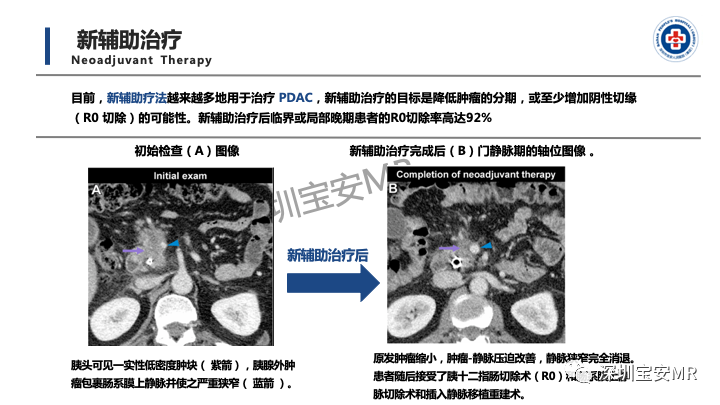 影像PPT - 【PPT】多模态影像对于胰腺癌分期意义-33