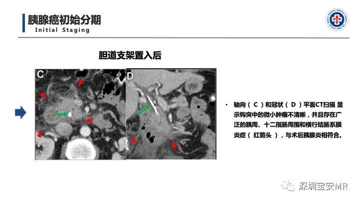 影像PPT - 【PPT】多模态影像对于胰腺癌分期意义-29