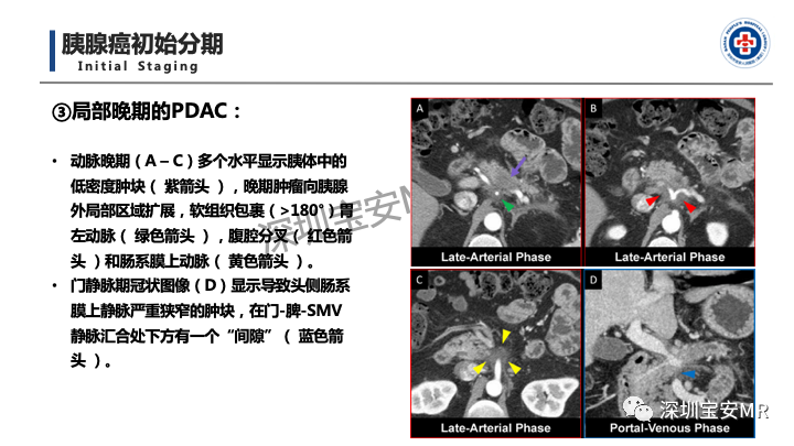 影像PPT - 【PPT】多模态影像对于胰腺癌分期意义-27