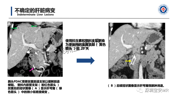 影像PPT - 【PPT】多模态影像对于胰腺癌分期意义-38