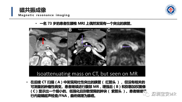 影像PPT - 【PPT】多模态影像对于胰腺癌分期意义-19