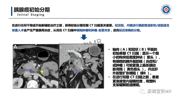 影像PPT - 【PPT】多模态影像对于胰腺癌分期意义-28