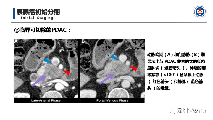 影像PPT - 【PPT】多模态影像对于胰腺癌分期意义-26