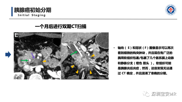 影像PPT - 【PPT】多模态影像对于胰腺癌分期意义-30