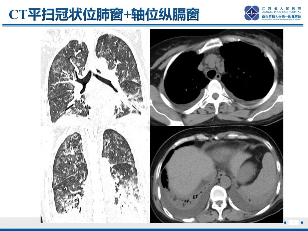 影像PPT - 【PPT】抗合成酶综合征相关间质性肺病-4