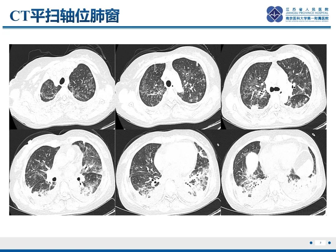 影像PPT - 【PPT】抗合成酶综合征相关间质性肺病-3