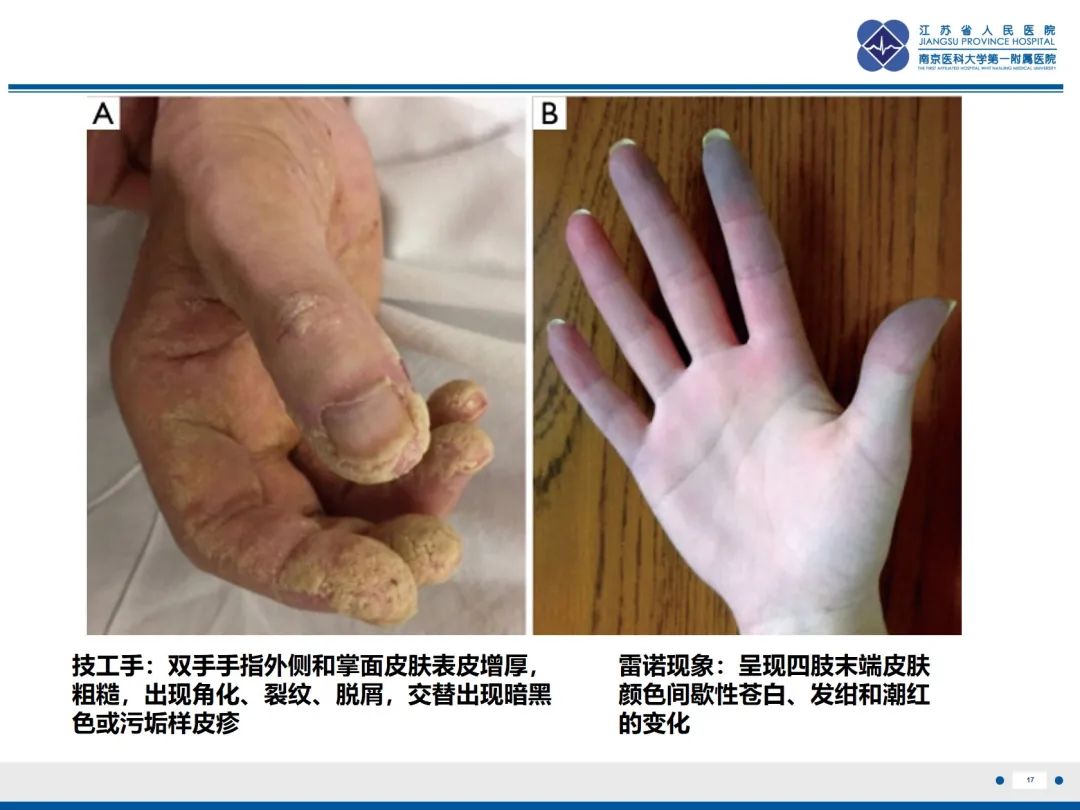 影像PPT - 【PPT】抗合成酶综合征相关间质性肺病-18