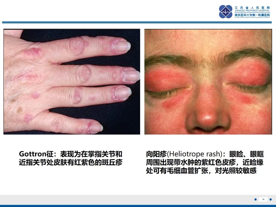 影像PPT - 【PPT】抗合成酶综合征相关间质性肺病-17