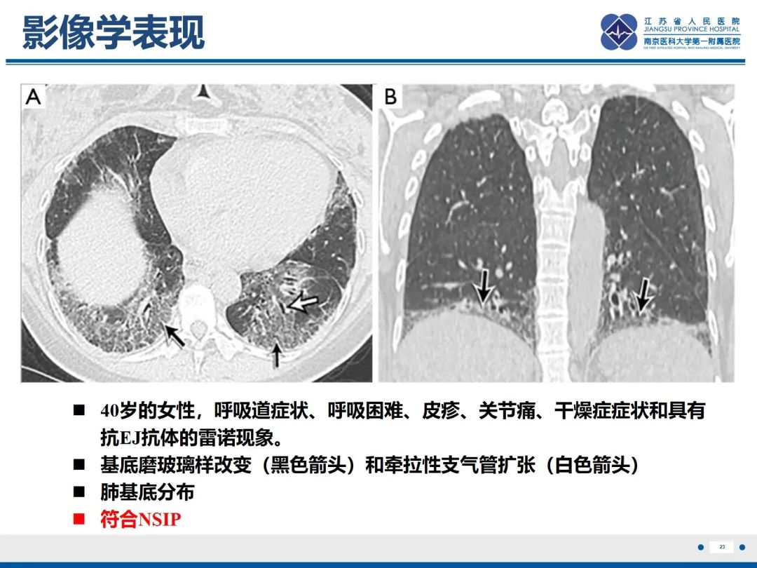 影像PPT - 【PPT】抗合成酶综合征相关间质性肺病-24