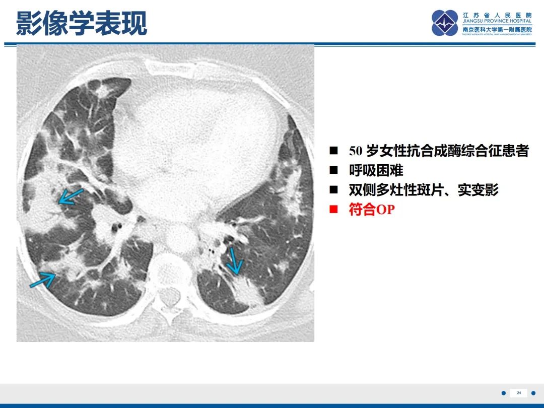 影像PPT - 【PPT】抗合成酶综合征相关间质性肺病-25