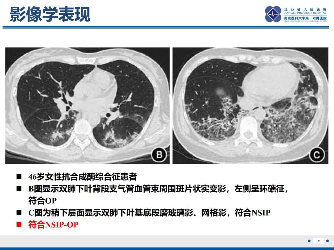 影像PPT - 【PPT】抗合成酶综合征相关间质性肺病-26